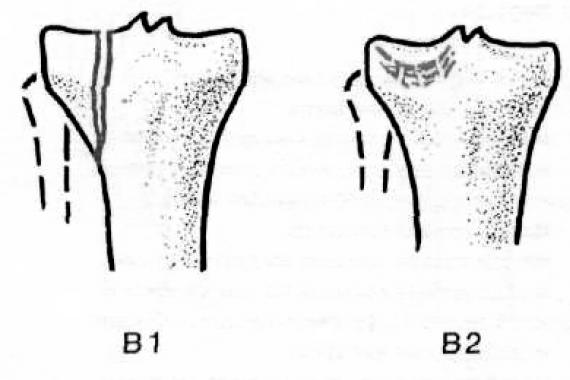 Fractures des condyles tibiaux : types, traitement Fracture sous-chondrale du condyle latéral